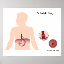 Affisch för Schatzki ringesophagus