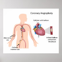Koronar angioplastyaffisch
