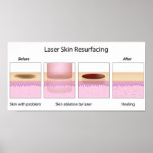 Laser flår resurfacing av tillvägagångssättaffisch