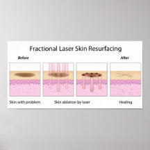 Obetydlig laser flår Resurfacing av affischen