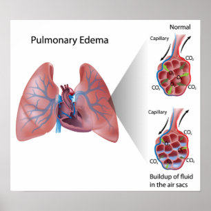 Affisch för Pulmonary edema