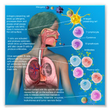 Allergiska: poster av IgE inflammatoriskt svar