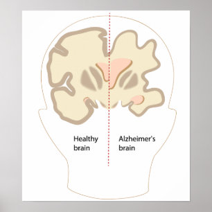 Alzheimers sjukdom Poster hjärnan