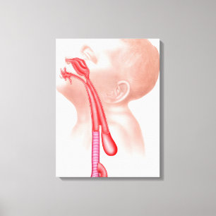 Anatomi av en Tracheoesophageal Fistula Canvastryck