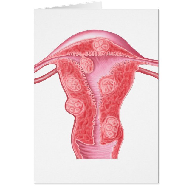 Anatomi av fibroida tumörer i kvinnligt Uterus Hälsningskort (Framsidan)