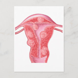 Anatomi av fibroida tumörer i kvinnligt Uterus Vykort