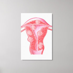 Anatomi av FibroidTumors i kvinnlig livmoder Canvastryck