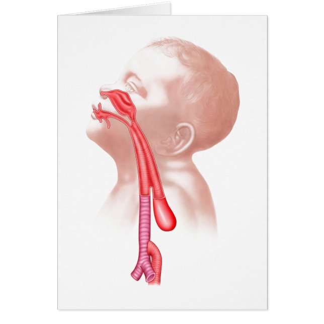 Anatomi i en trakeesofageal Fistula Hälsningskort (Framsidan)