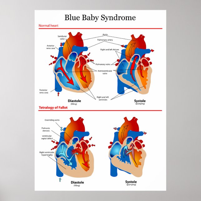 Anatomiskt hjärtdiagram över blått Baby- syndrom Poster (Framsidan)