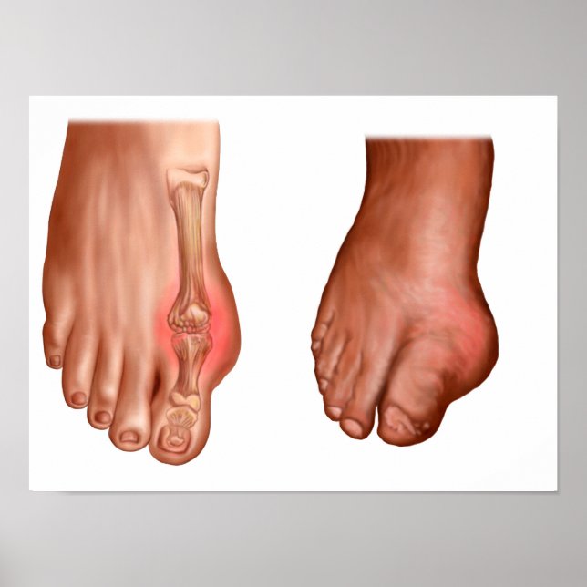 Anatomy Of A Swollen Foot Poster (Framsidan)