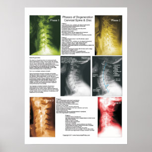 Arrangerar gradvis den Cervical ryggrads- Poster