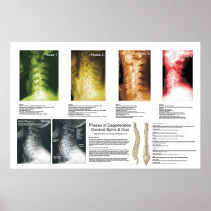 Arrangerar gradvis den Cervical ryggrads- Poster
