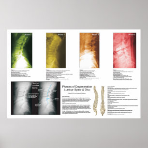 Arrangerar gradvis den ryggrads- poster