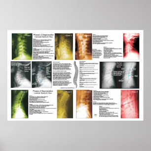 Arrangerar gradvis den ryggrads- poster
