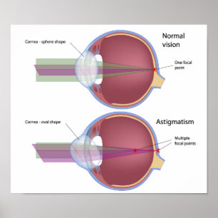 Astigmatism, en vanlig defekt i öga Poster