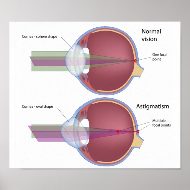 Astigmatism, en vanlig defekt i öga Poster (Framsidan)