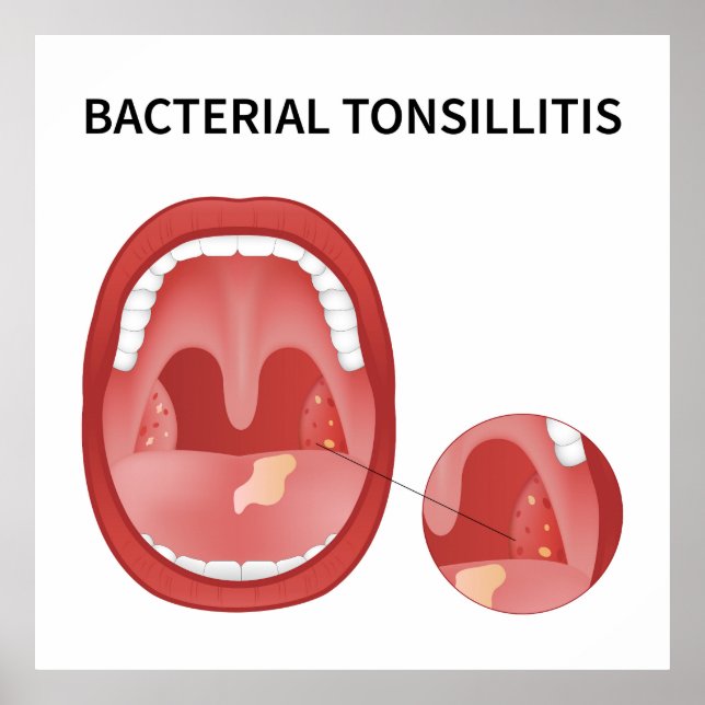 Bakteriell tonsillit poster (Framsidan)