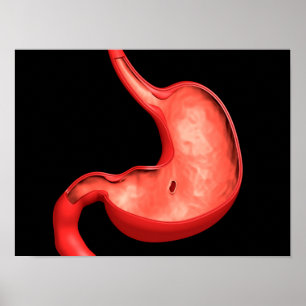 Begreppsmässigt avbilda av Peptic sår i mage Poster