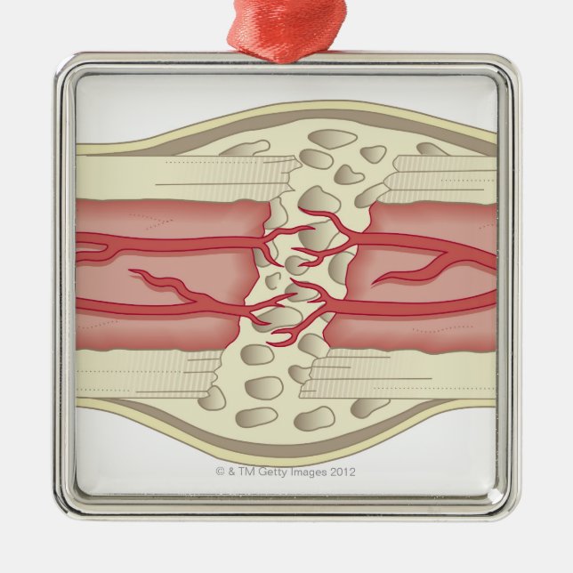 Ben som reparerar sig 2 julgransprydnad metall (Framsidan)
