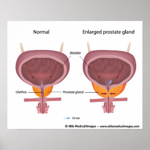 Benign prostatahyperplasi, märkt diagram. poster