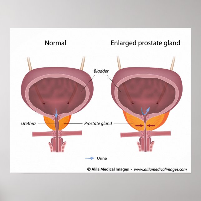 Benign prostatahyperplasi, märkt diagram. poster (Framsidan)