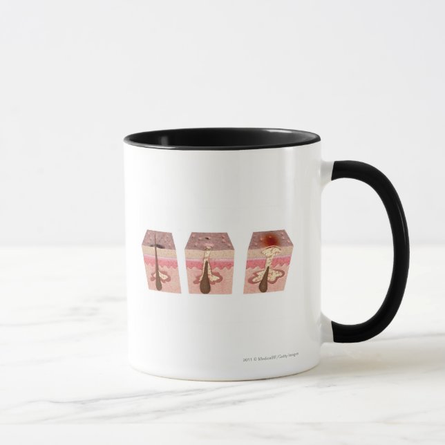 Beskåda av vad orsakar acne mugg (Höger)