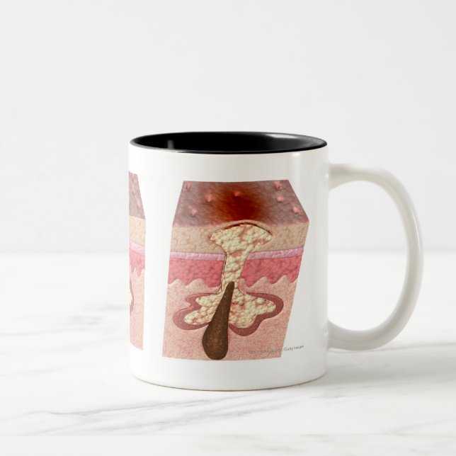 Beskåda av vad orsakar acne Två-Tonad mugg (Höger)