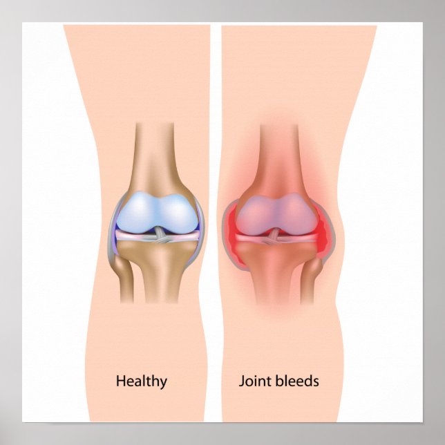 Blödningar i hemofili Poster (Framsidan)