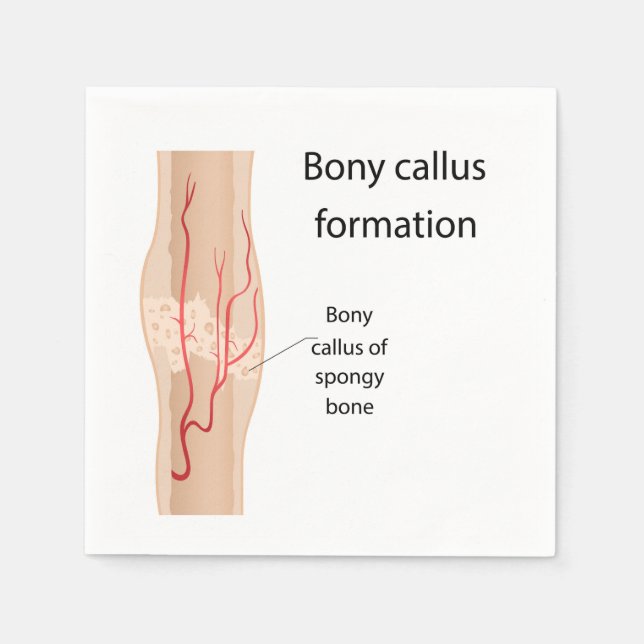 Bony callus formation pappersservett (Framsidan)