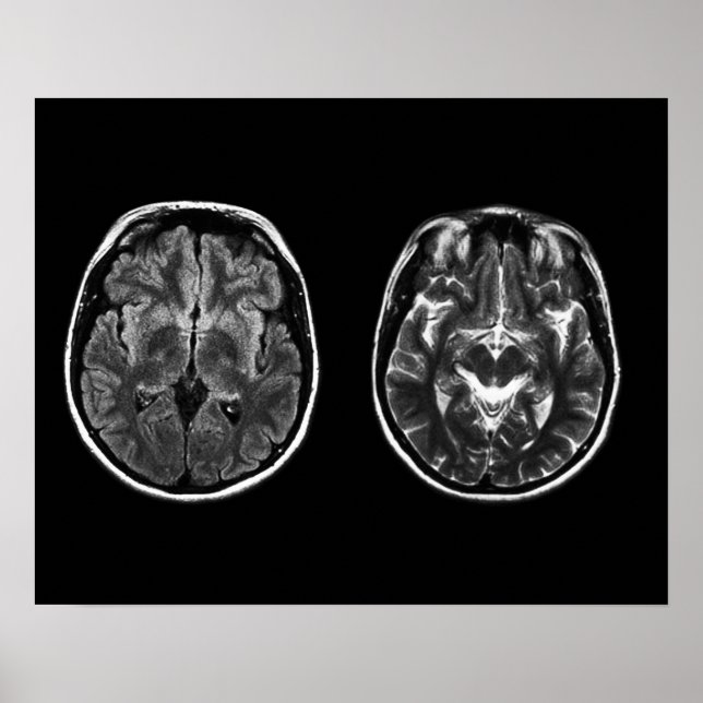 Brain Mri scan Poster (Framsidan)