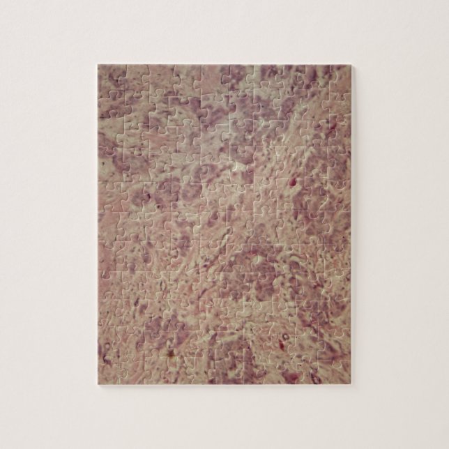 Bröstcancer under mikroskopet pussel (Vertikal)