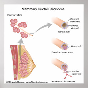 Cancercancer i bröstcancer, märkt diagram. poster