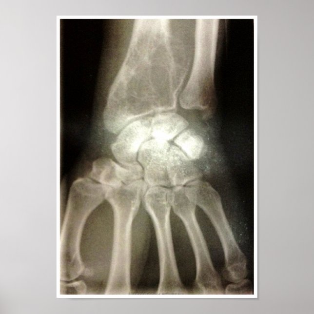 Carpals Xray Poster (Framsidan)
