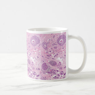 Celler för kaffeMugg-Bröst cancer Kaffemugg