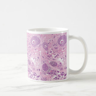Celler för kaffeMugg-Bröst cancer Kaffemugg