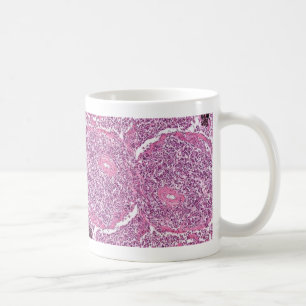 Celler för kaffeMugg-Lung cancer Kaffemugg