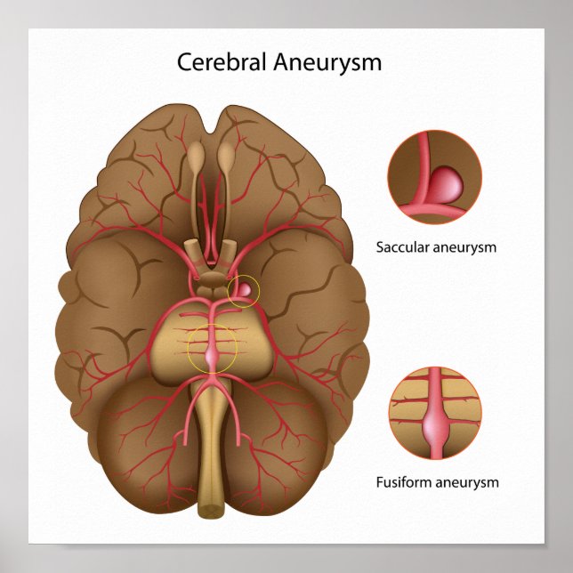 Cerebral aneurysm Poster (Framsidan)