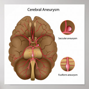 Cerebral aneurysmaffisch poster