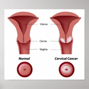 Cervixcancer Poster