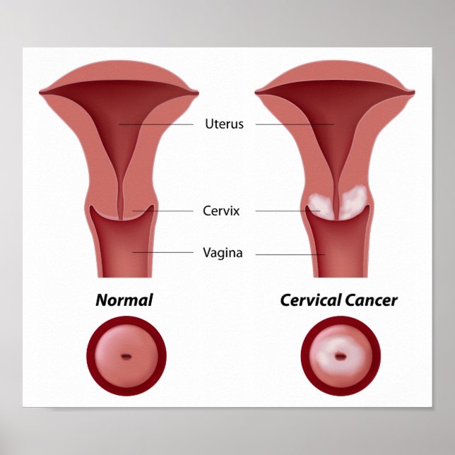 Cervixcancer Poster (Framsidan)