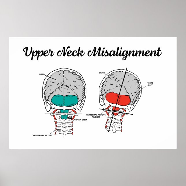 Chiropraktic Upper Cervical Poster (Framsidan)