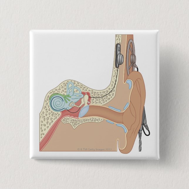 Cochlear Implantat Knapp (Framsida)