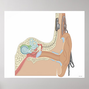Cochlear implantat poster
