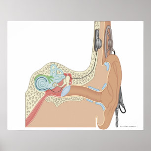 Cochlear implantat poster
