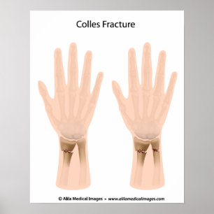 Colles bryter, den medicinska illustrationen poster