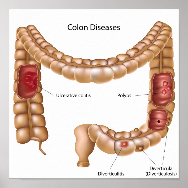 Colon pathologilogies Poster (Framsidan)