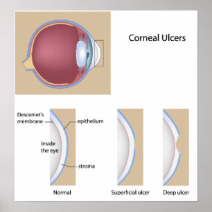 Corneal ulcer öga villkor Poster