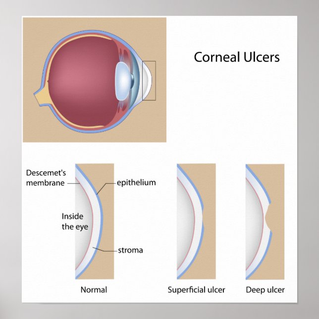 Corneal ulcer öga villkor Poster (Framsidan)
