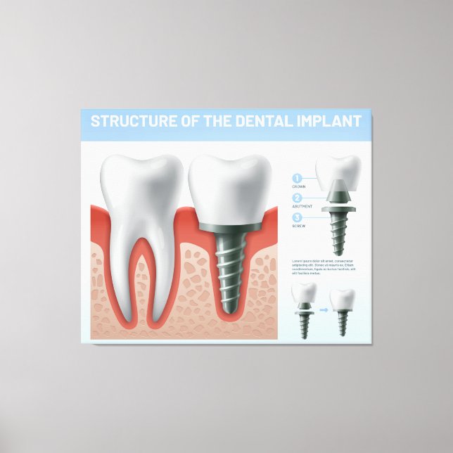 Dentalimplantatets struktur canvastryck (Framsida)
