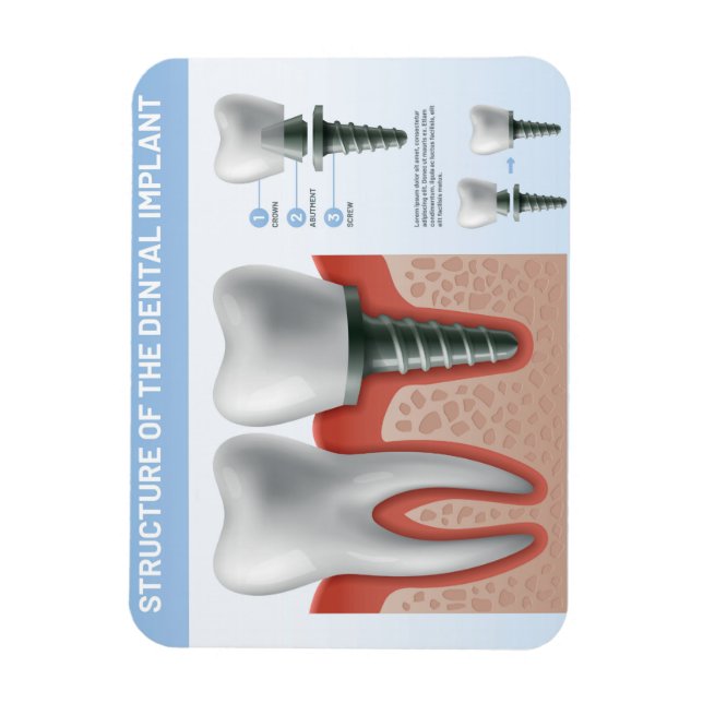 Dentalimplantatets struktur magnet (Vertikal)